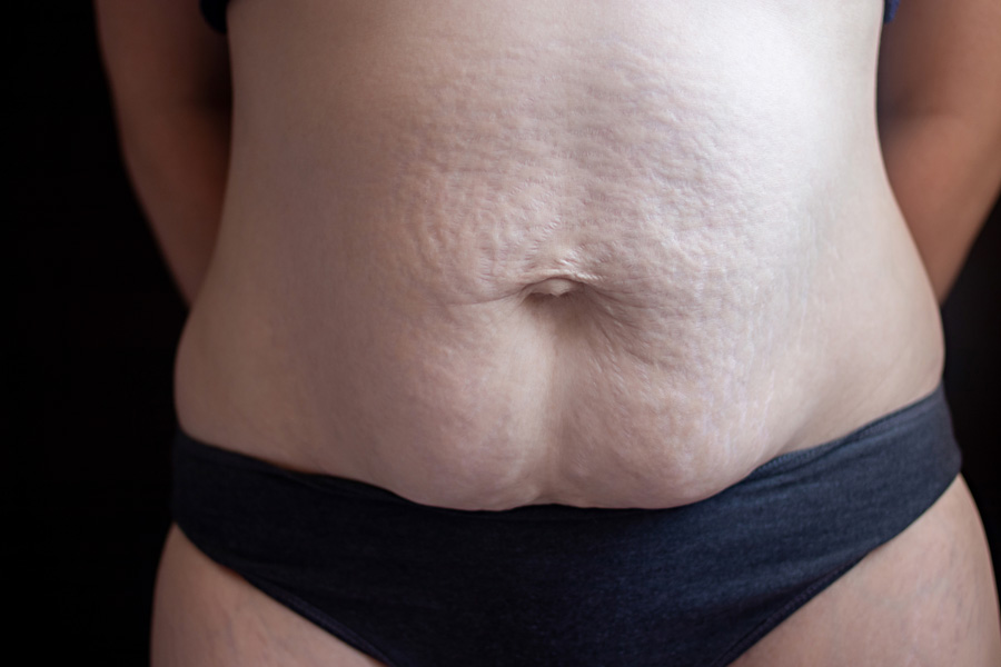 Breast Augmentation Services